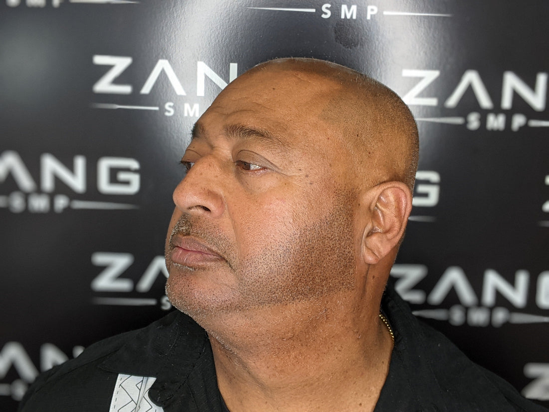 Client of Zang SMP getting beard pigmentation done by Zang SMP.