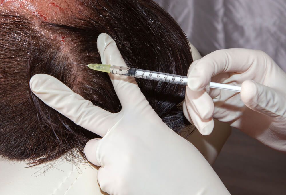 Exploring the Best Hair Loss Treatments of 2024