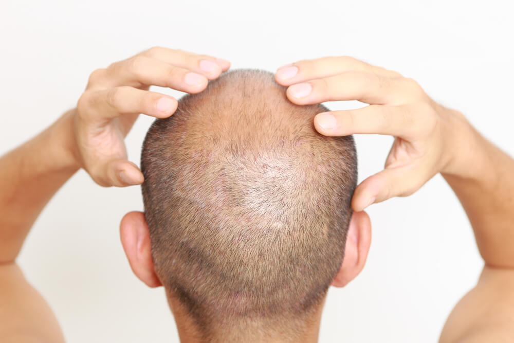 Why SMP Is Your Best Bet for Beating Hair Loss