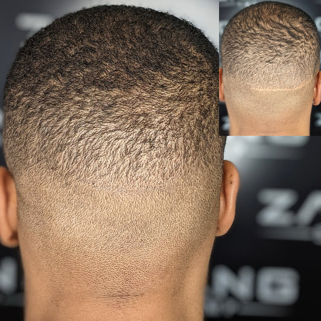 Client receiving scar concealment on a previous hair transplant surgery scar from Zang SMP