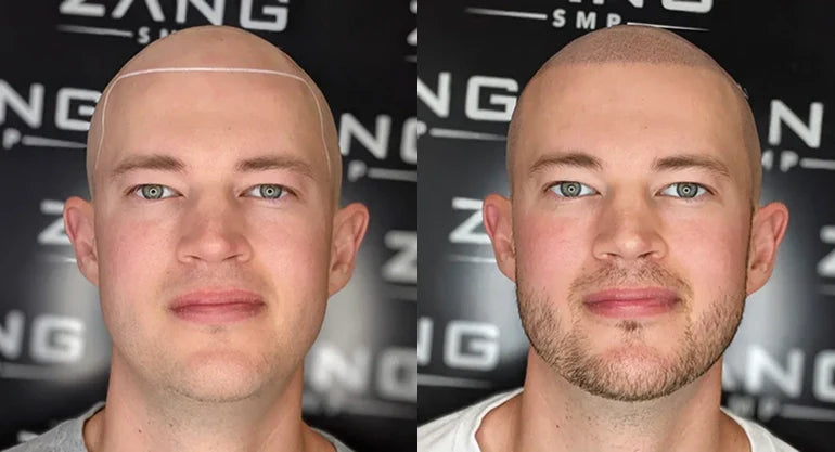 Achieving a Natural Look: How To Fix Unnatural SMP Hairlines Without Laser Intervention