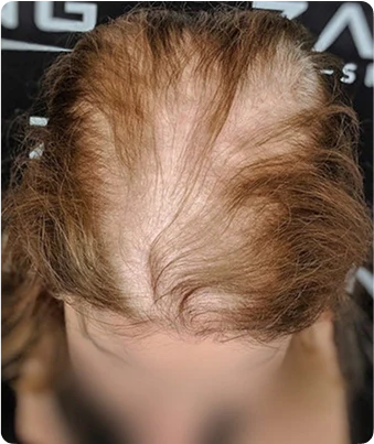Exploring Scalp Micropigmentation: A Viable Alternative to Female Hair Transplants in Los Angeles