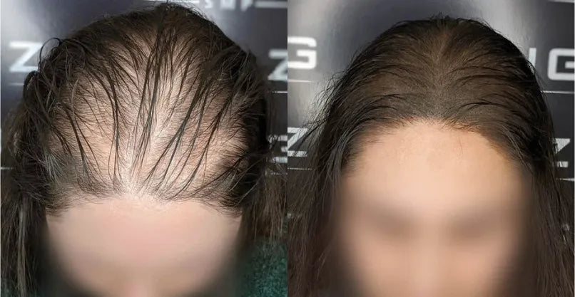 Causes of Female Pattern Baldness in Young Women