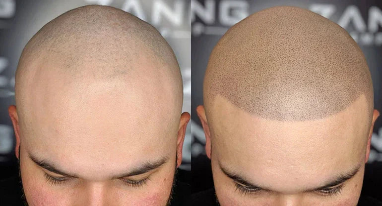 SMP for Male Pattern Baldness in Orange County