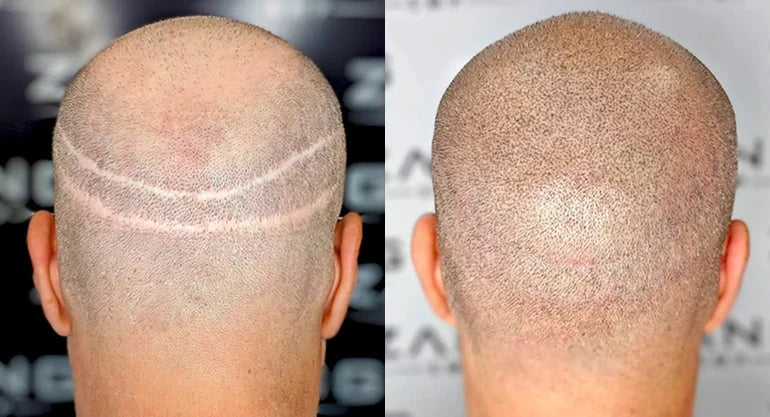 Faded SMP? How To Refresh and Revitalize Your Scalp Micropigmentation without Lasers