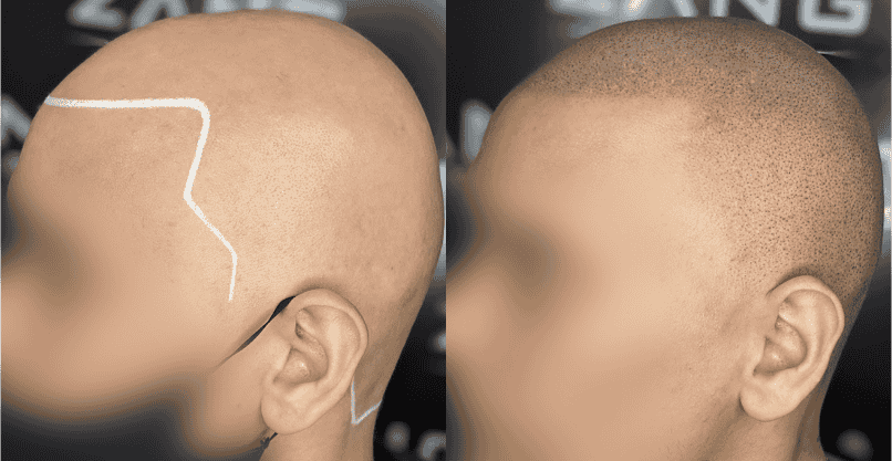 The Cost of Scalp Micropigmentation: Understanding Your Investment