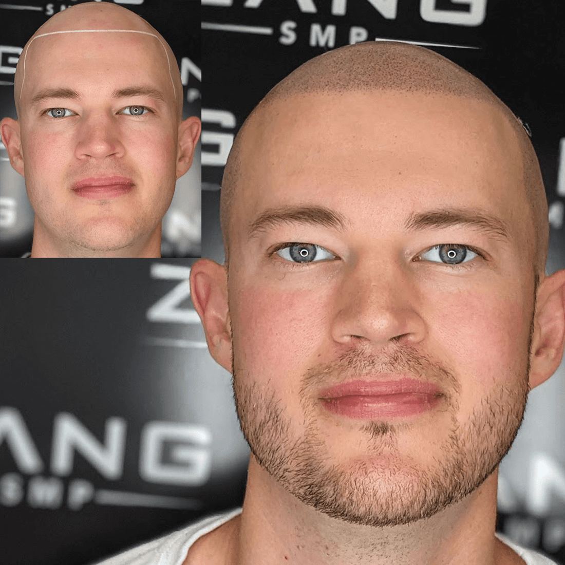 Hair Tattoo: Redefine Hairline for Men