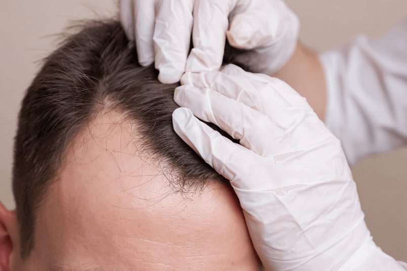 Scalp Micropigmentation Cost Unveiled - Zang SMP