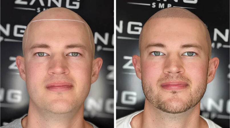 How Scalp Micropigmentation is Revolutionizing Hair Loss Treatment