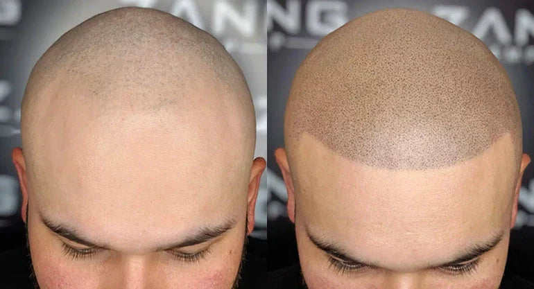 SMP Repair Success Stories: Transformations Without the Need for Laser Removal