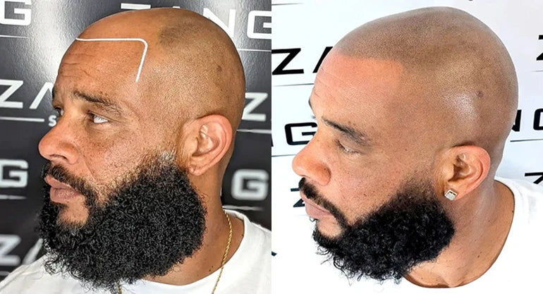 Scalp Micropigmentation for Male Pattern Baldness: What You Should Know