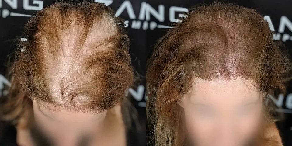 Scalp Micropigmentation for Women: Breaking Beauty Standards