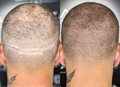 Scar Camouflage with Scalp Micropigmentation