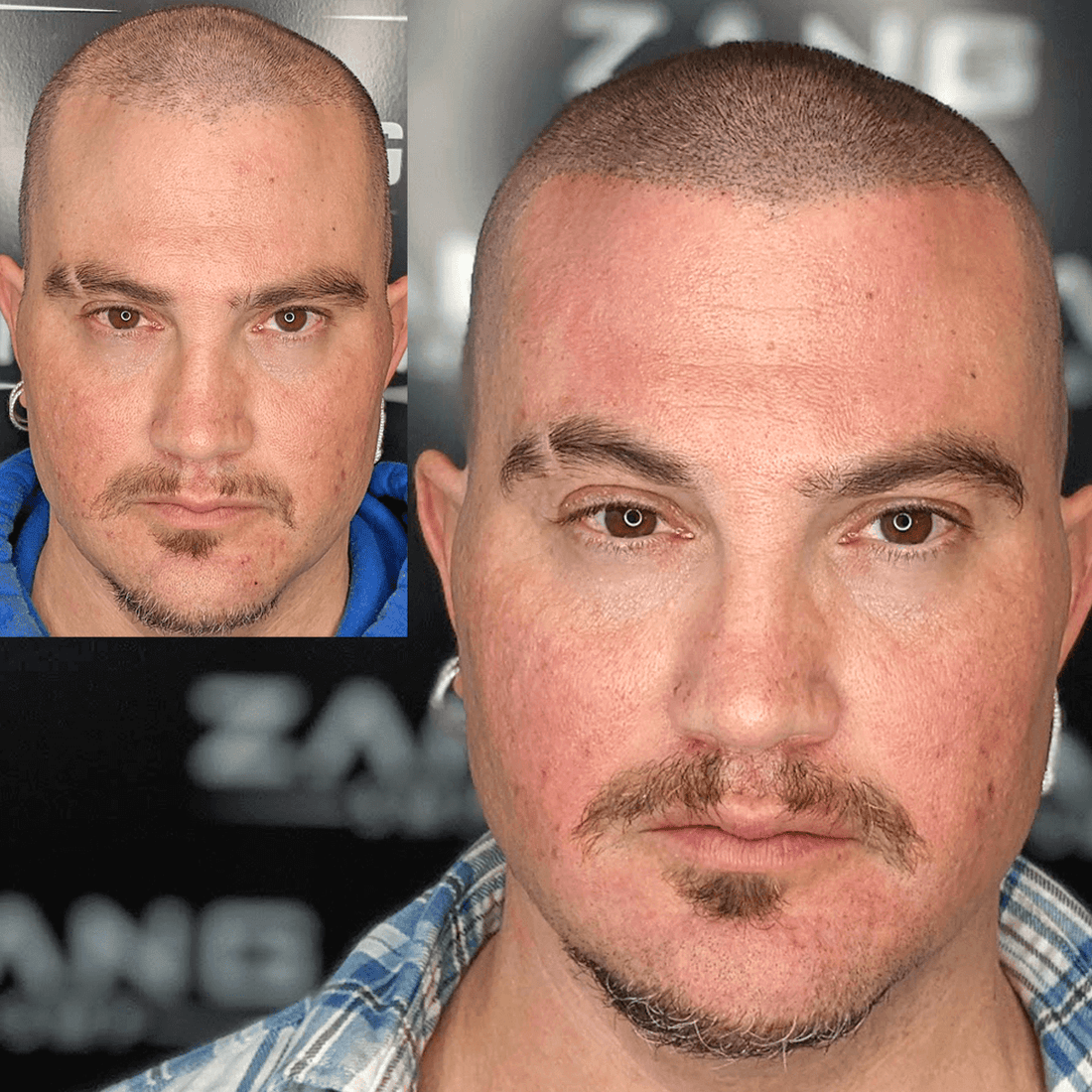 Scar Micropigmentation for Seamless Camouflage