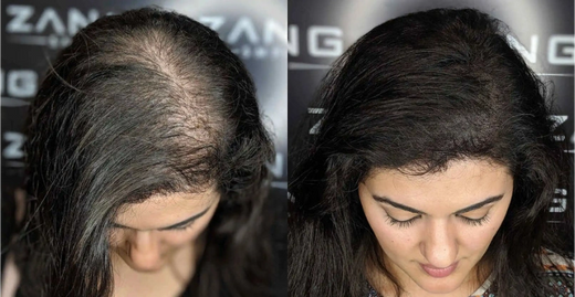 Symptoms and Early Signs to Look Out For: Female Pattern Baldness