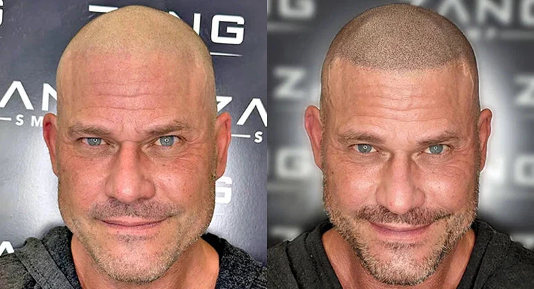 Understanding SMP Pigment Migration: Correction Techniques without Laser Treatment