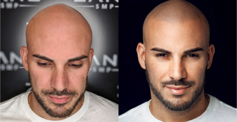 Scalp Micropigmentation: The Complete Guide | Zang SMP