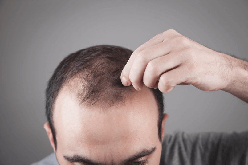 Unraveling The Mysteries The Root Causes Of Hair Loss Zang Smp