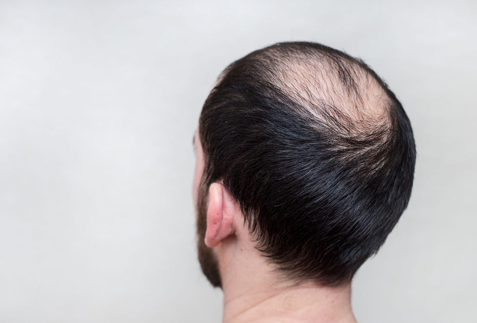 Hair Loss Shampoo And More 3 Surprising Facts About Hair Loss Zang Smp