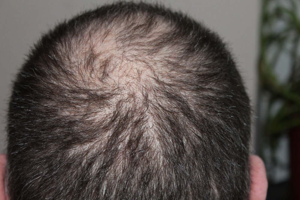 How Stress Contributes to Hair Loss: Five Key Insights