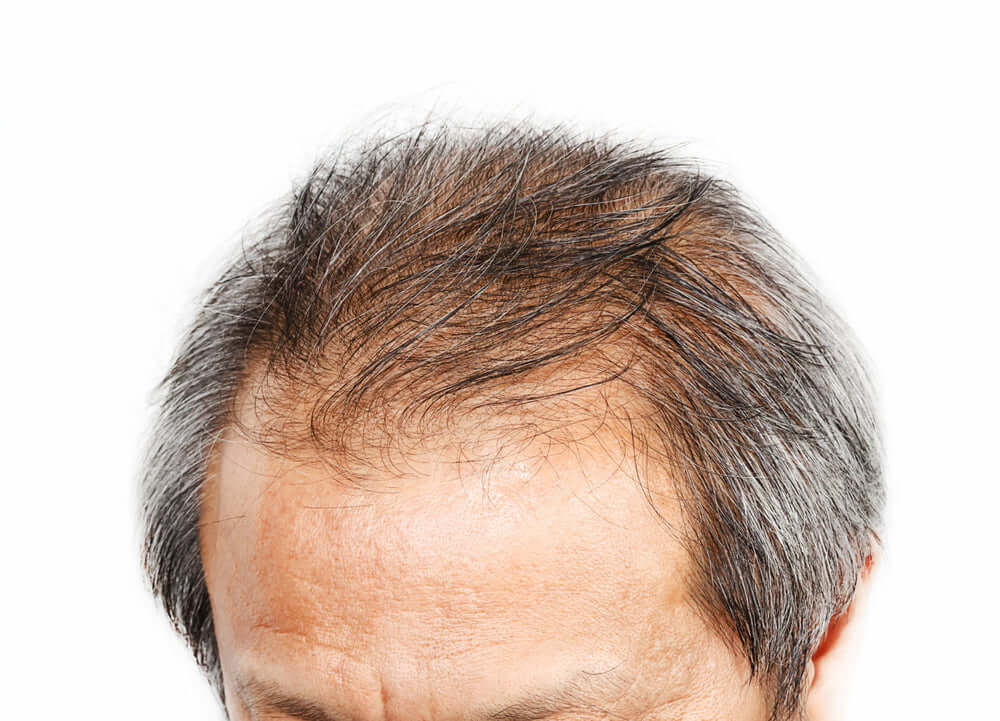 Five Reasons Behind Men's Thinning Hair