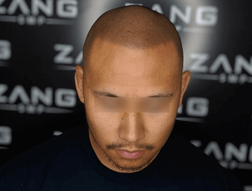 Choosing Between Permanent and Temporary Scalp Micropigmentation