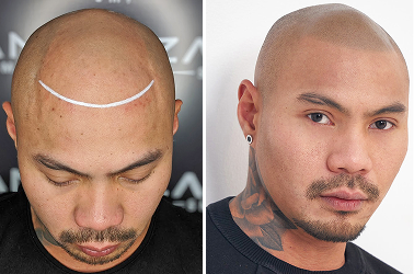 Alopecia