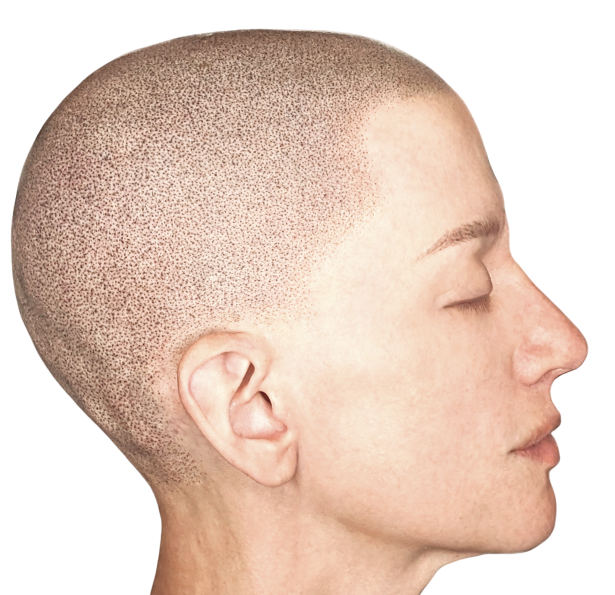 Alopecia_image