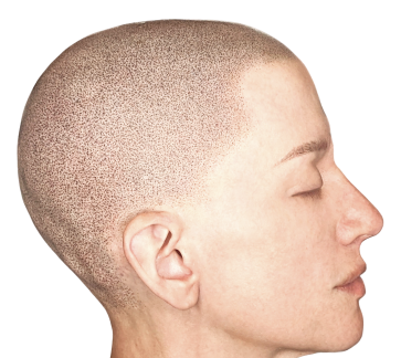 Alopecia_image_mobile