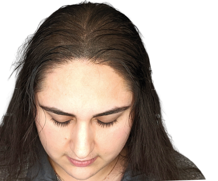 What_causes_Female_Pattern