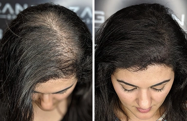 female_pattern_hair_loss