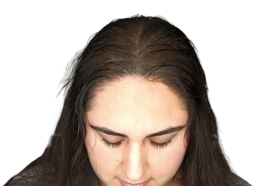 What_causes_Female_Pattern
