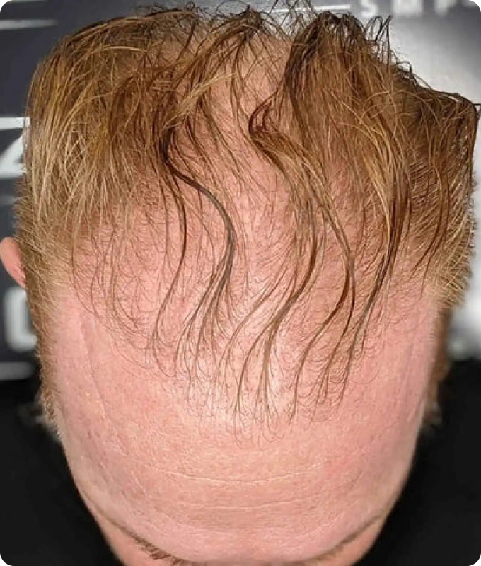 hair_filler_img_1