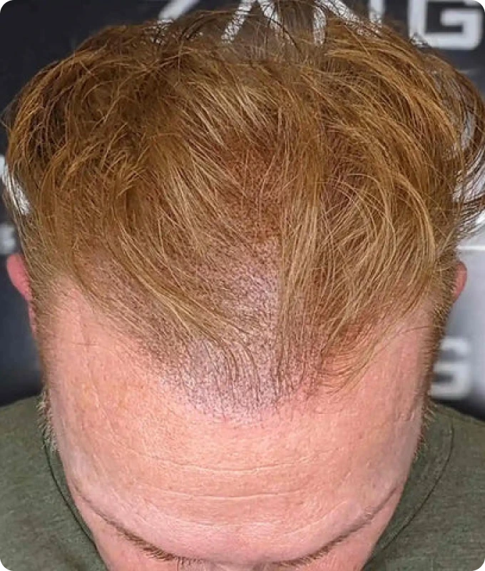 hair_filler_img