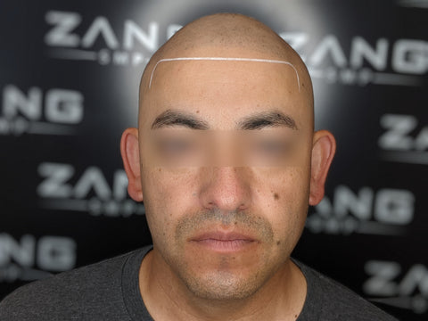 hairline-repair_