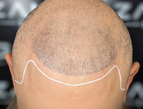 Scalp