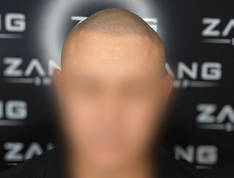 bald