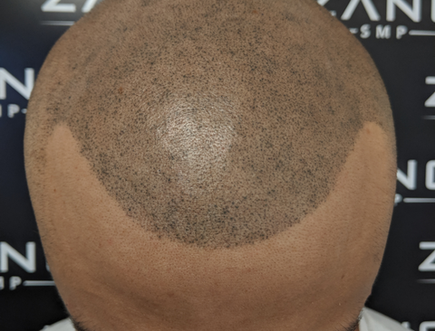 Scalp