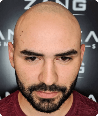 What is male pattern baldness?