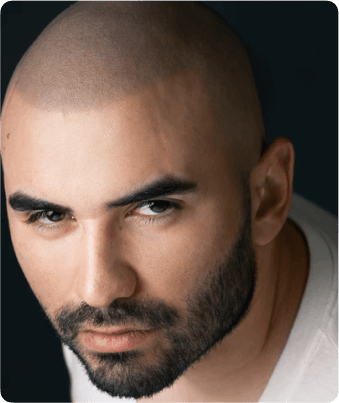What is male pattern baldness?