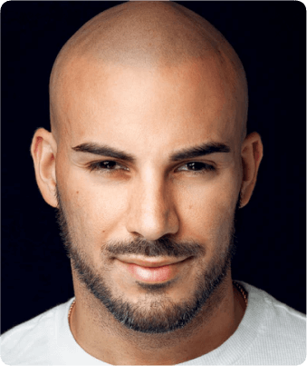 What is male pattern baldness?
