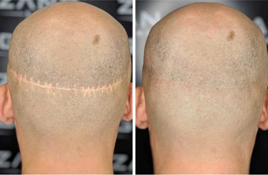 scar