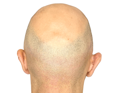 scar_conceal