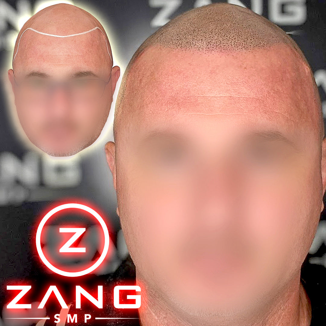 Client with natural hair tattoo - scalp micropigmentation - results done by Zang SMP.