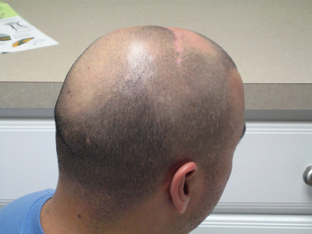 Recognizing the Signs of Unusual Hair Loss