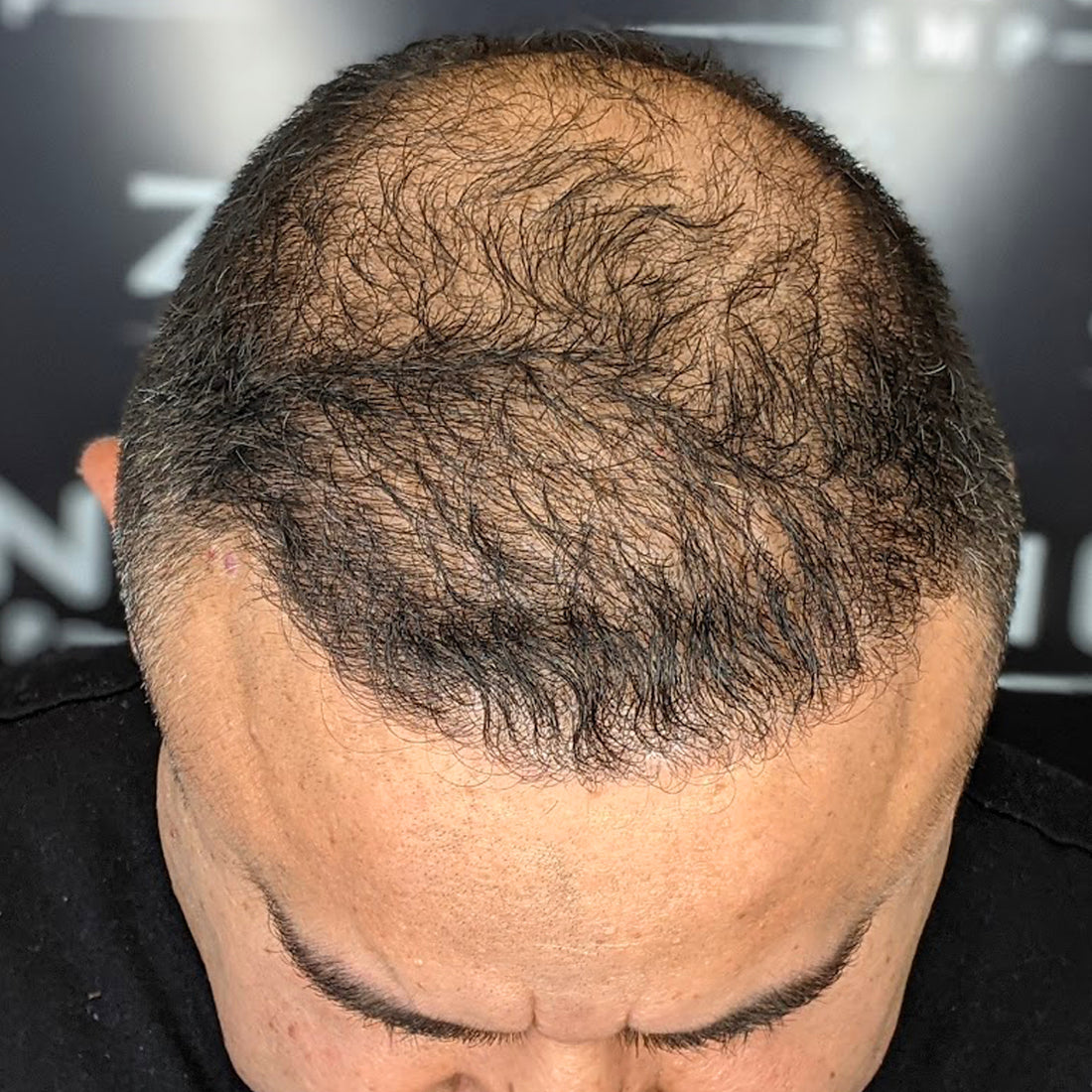 Client with hair thinning coming to Zang SMP for scalp micropigmentation services 