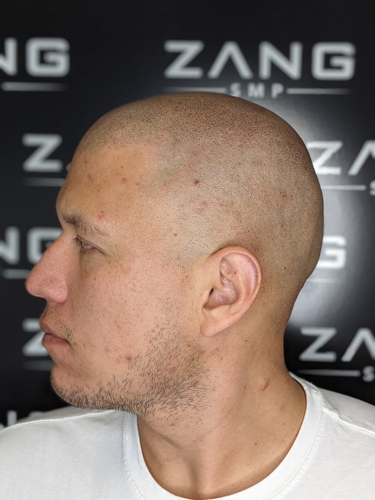 Itchy Scalp Thinning Hair Solution: Scalp Micropigmentation - Zang SMP