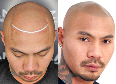 Scalp Micropigmentation: Hair Tattoo Guide - Zang SMP