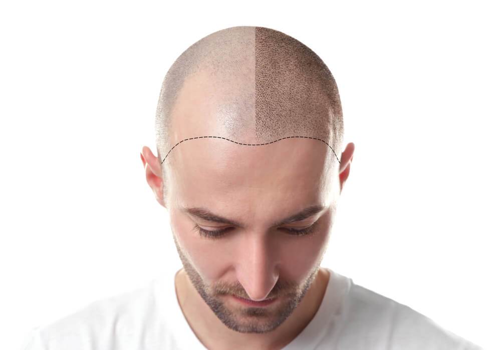 What to Do with a Bad Tattooed Hairline  Possible Fixes