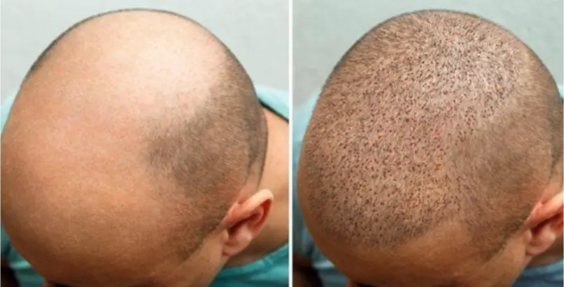 5 Reasons Why Scalp Micropigmentation is Gaining Popularity